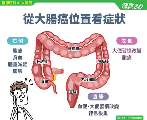 大腸癌／一定會血便嗎？左右側大腸癌症狀不一樣！1種息肉會變癌 結腸癌 直腸癌 大腸直腸癌｜健康2 0