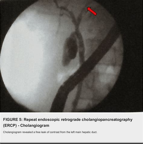 Figure 1 From Complication Of Hepatic Hydatid Cyst Surgery Presenting As Obstructive Jaundice