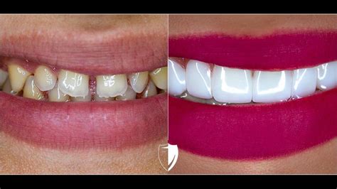 Veneers Before And After | Brighter Image Lab Gallery [2020]