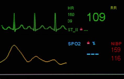 What Is Considered A Normal Heart Rate With Pictures