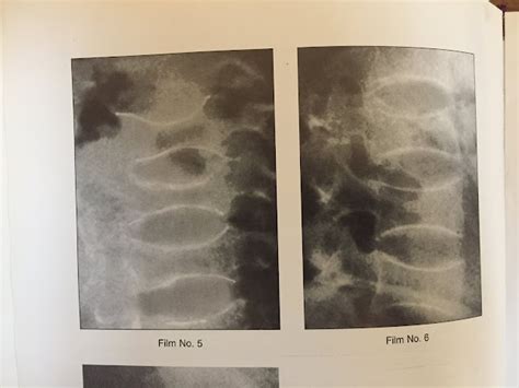 XRAYS OF RICKETS DISEASE