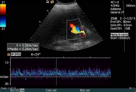 Figure 3 From Role Of Colour Doppler Ultrasonography Cdus In