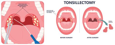 Tonsillar Crypts