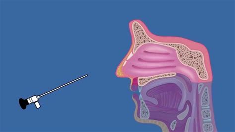 What Is Nasal Endoscopy Youtube