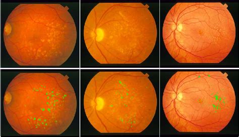 Figure 2 From Automated Drusen Segmentation In Fundus Images For