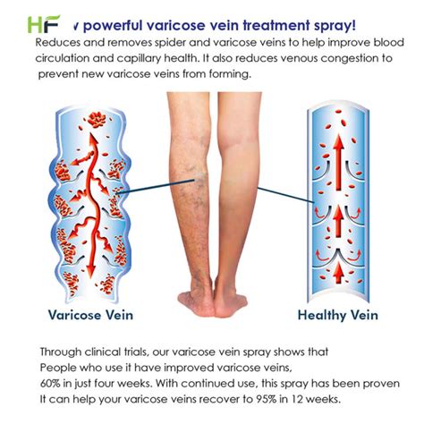 Varicose Vein Massage Spray Vein Remover Varicose Veins Treatment Vasculitis Angiitis Remedy