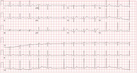 Grad Student With Palpitations | Clinician Reviews