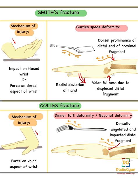 Smith Fracture - Distal Radial Fracture | Radiology Case | - RadioGyan