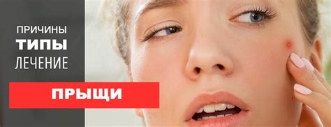 Прыщи на лице: симптомы, причины и лечение в домашних условиях