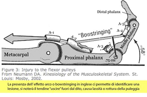 Le Lesioni Della Puleggia Nei Climbers Fisioterapia Genova