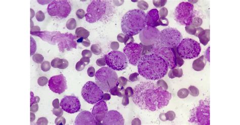 Acute Promyelocytic Leukemia Patient 