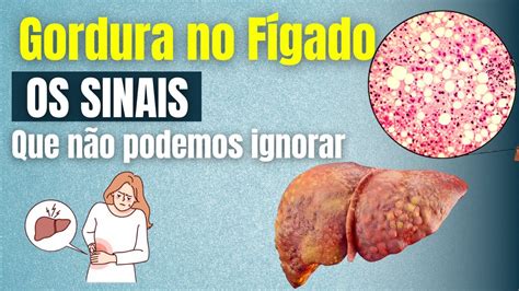 Esteatose Hepática Entenda os Sinais do Acúmulo de Gordura no Fígado