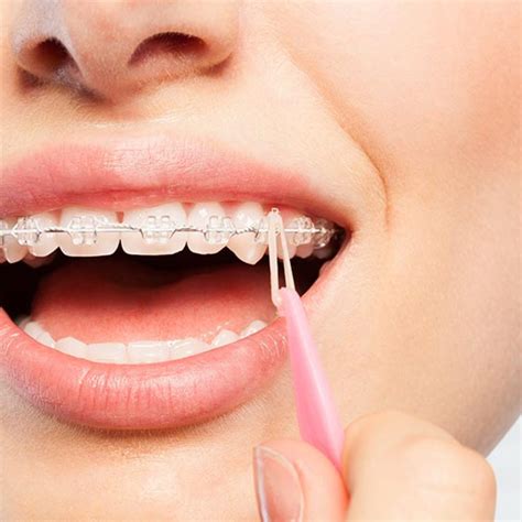 Ortodoncia con Brackets en Bilbao Clínica Dental Santisteban