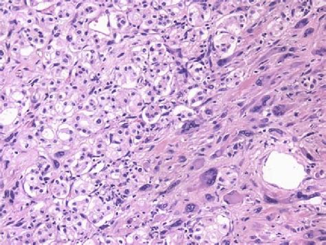 Rhabdoid Morphology Right In Association With Chromophobe Rcc