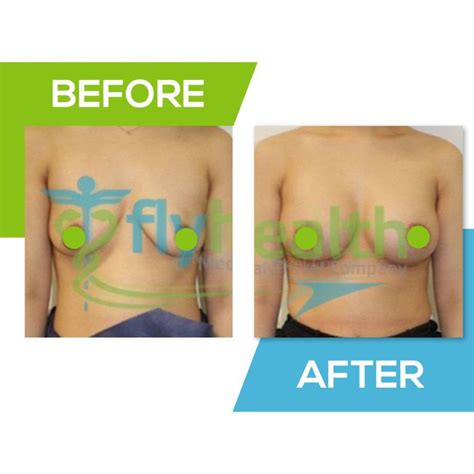 Boob Job Turkey Breast Implants With FlyHealth Istanbul