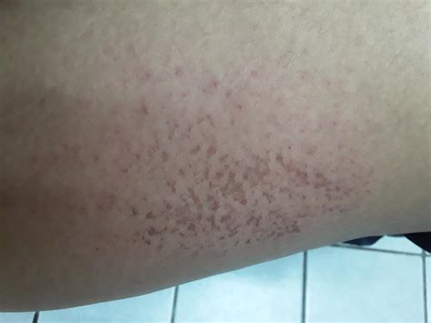 This is from scratching. It's on my outer thigh. I have a few more on