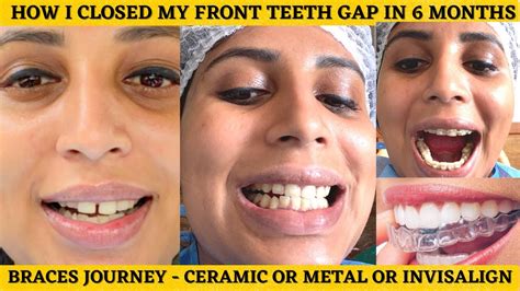 Ceramic Braces Or Invisalign Cost Of Braces Closing My Front Teeth