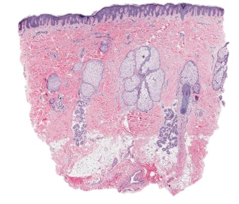 Scarring Alopecia Histology