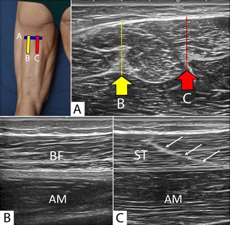 Introduction To Diagnostic Ultrasound Of Hamstring Muscles Sports Medicine Review