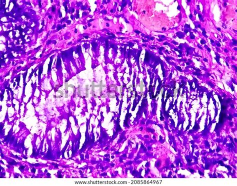 Benign Hyperplastic Polyp Colon Notice Typical Stock Photo 2085864967 | Shutterstock