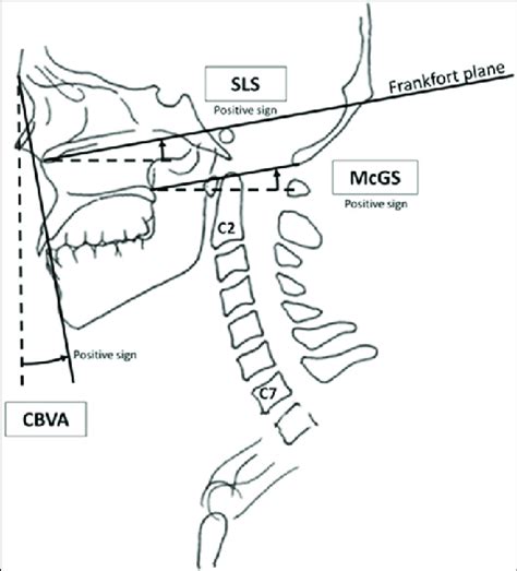 Measured Upper Cervical Parameters Including Sls Slope Of Line Of