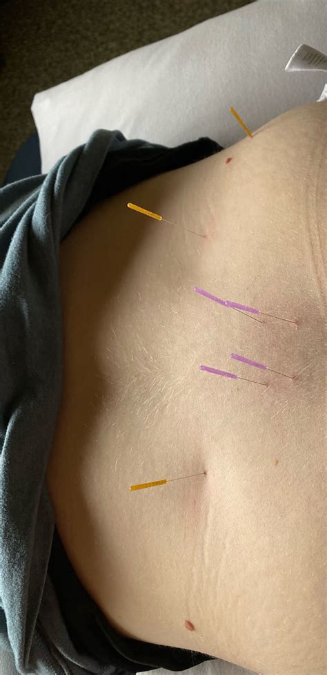 Dry Needling For The Pelvic Floor