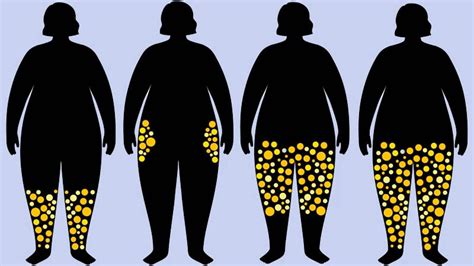 Lipedema Uma Doença Comum Mas Ainda Pouco Conhecida