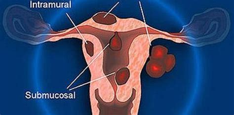 Qué es un fibroma uterino