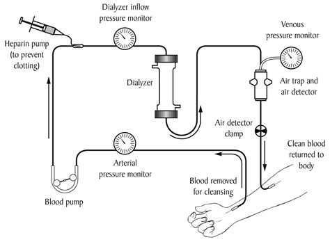 Hemodialysis Diagram