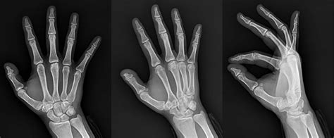 Anteroposterior View Of The Right Hand Middle Finger Mcp Joint Showing Download Scientific