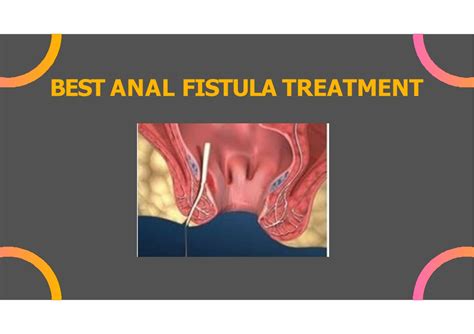 Ppt Best Fistula Treatment In India Powerpoint Presentation Free