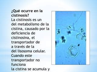 Cistinosis PPT