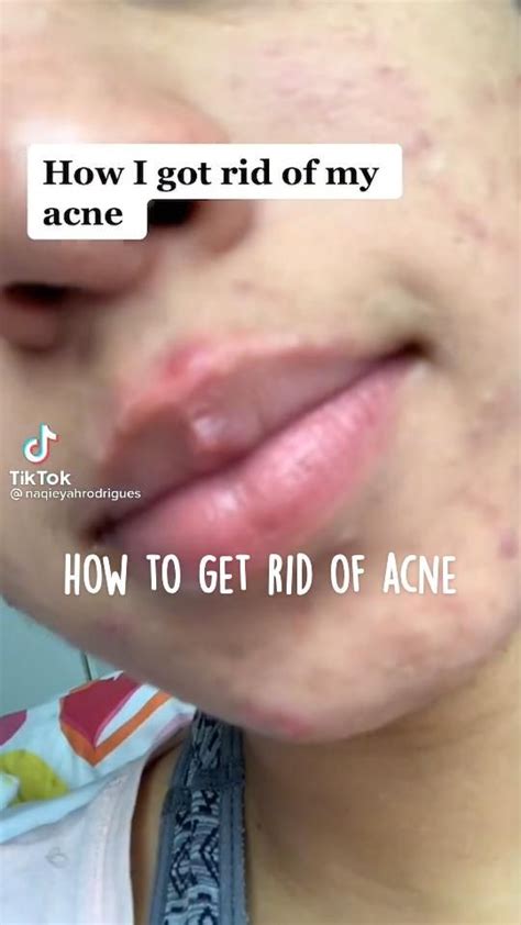 How To Get Rid Of Acne Artofit