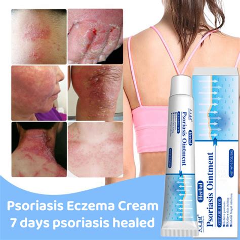 Antibacterial Psoriasis Cream Herbal Treatment Eczema Relief Itch Rash