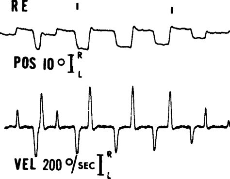 Figure 1 From Inverse Latent Macro Square Wave Jerks And Downbeat