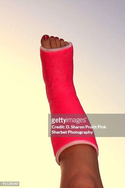 Broken Foot Cast Photos and Premium High Res Pictures - Getty Images