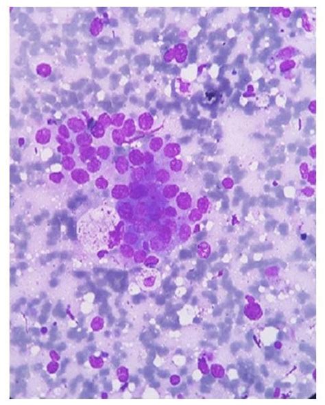 High Power View Of Cytology Smear Showing Tumor Cells Exhibiting Download Scientific Diagram