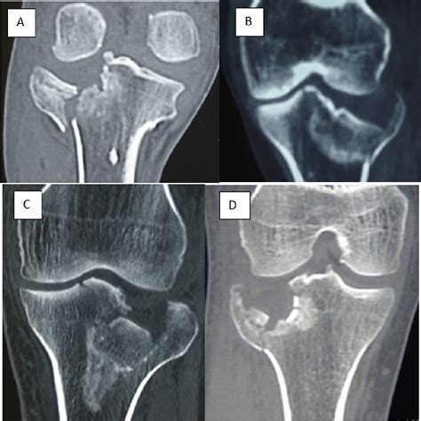 Figure 2 From Are All Schatzker Type Ii Tibial Plateau Fractures Alike