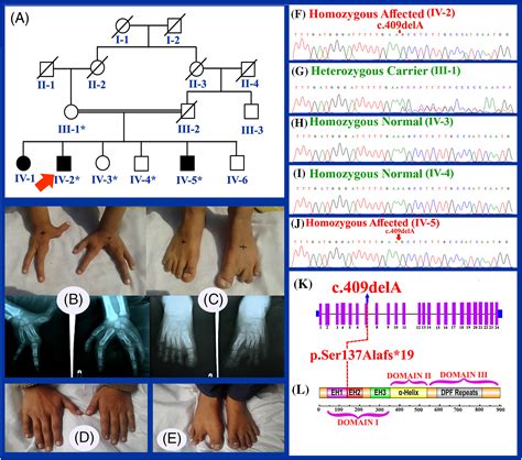 First Direct Evidence Of Involvement Of A Homozygous Loss‐of‐function