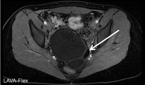 Ovarian Dermoid Cyst Mri Radiologypics Com