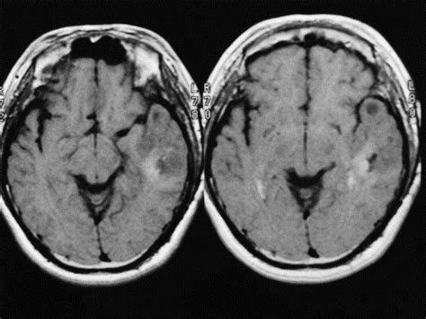 Disseminated Spread Of Recurrent Oligodendroglioma Who Grade Ii