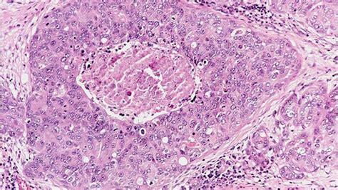 Types Of Breast Cancer Breast Pathology Johns Hopkins Pathology