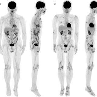 Typical Fdg Pet Maximum Intensity Projection Mip Images Of Patients