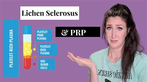 Lichen Sclerosus Treatment Options Part 2 Platelet Rich Plasma YouTube