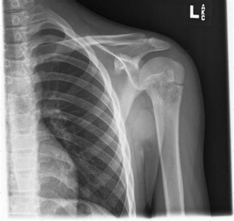 X Ray Of Left Shoulder Shows Destructive Lesion Of Hume Open I