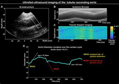 Frontiers Methods Aortic Wall Deformation Assessment By Ultrafast