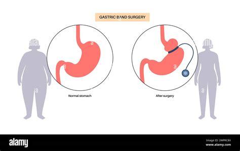 Gastric Band Medical Procedure Illustration Adjustable Gastric