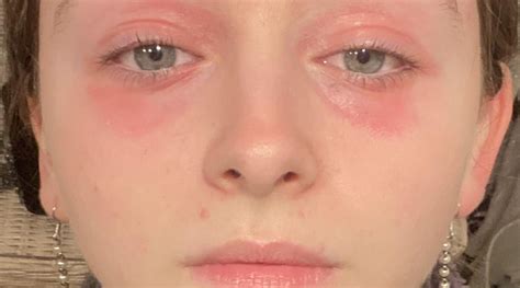 Help With Skin Around Eyes R Skincareaddicts