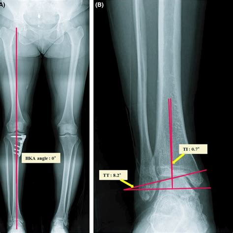 Before High Tibial Osteotomy HTO Whole Leg Radiographs Of A 59yold