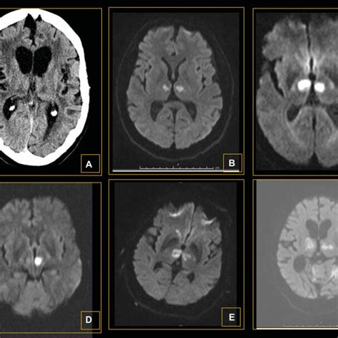 Representative Radiologic Appearance Of The Artery Of Percheron